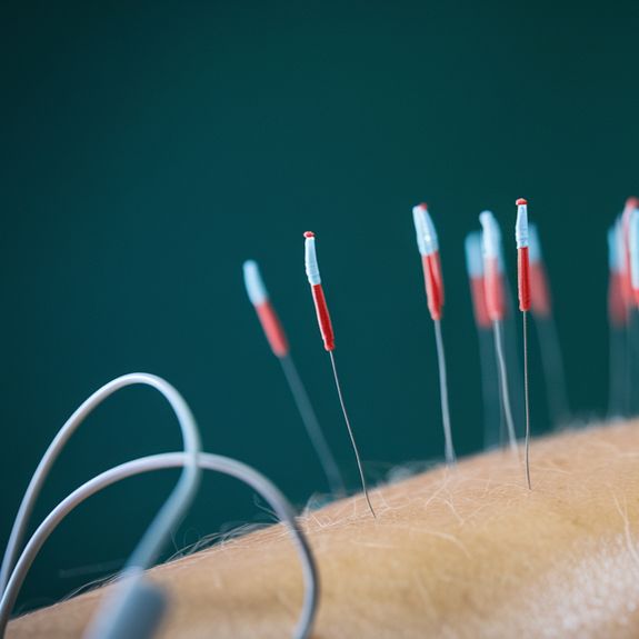 Electro-Acupuncture