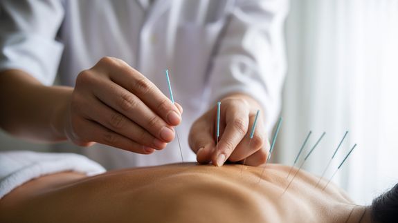 From above of crop anonymous man applying needles on back of client during acupuncture procedure
