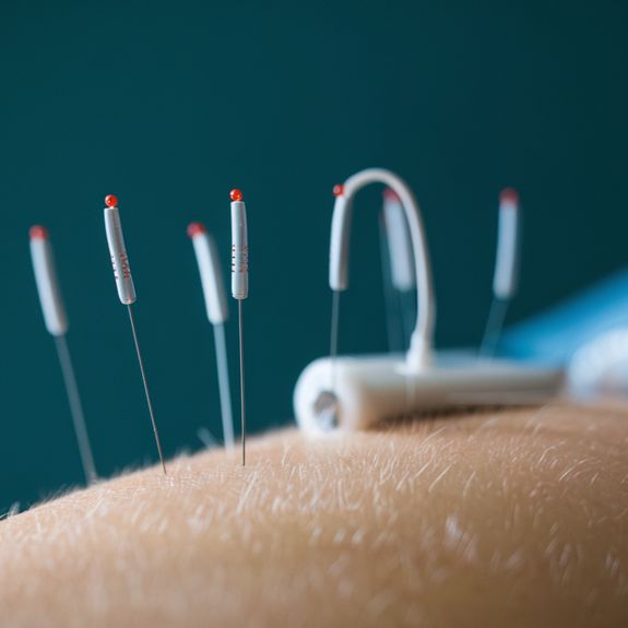 Electro-Acupuncture