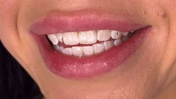 Add Sparkle to Your Smile – North Lakes Style