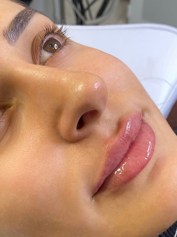 Reduces Acne Scars and Pigmentation