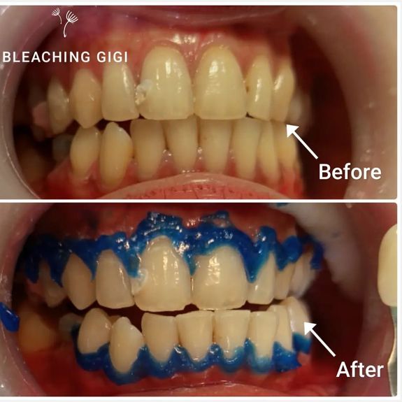 Bleaching
