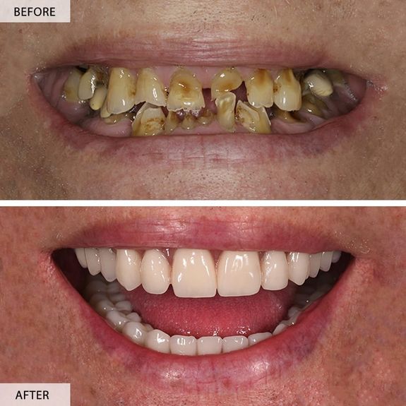 All-on-four Dental Implants, Implants with Crown & Bridge